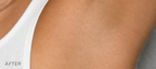 Hair Removal Soothing Essence Roller